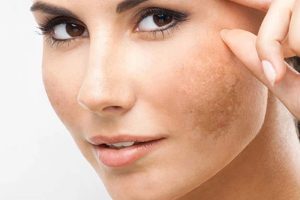 Ai nên thực hiện tiêm điều trị nám mesotherapy? 