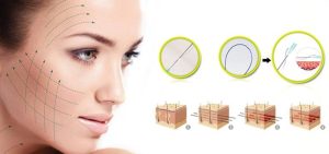 Căng da mặt bằng chỉ collagen là gì?