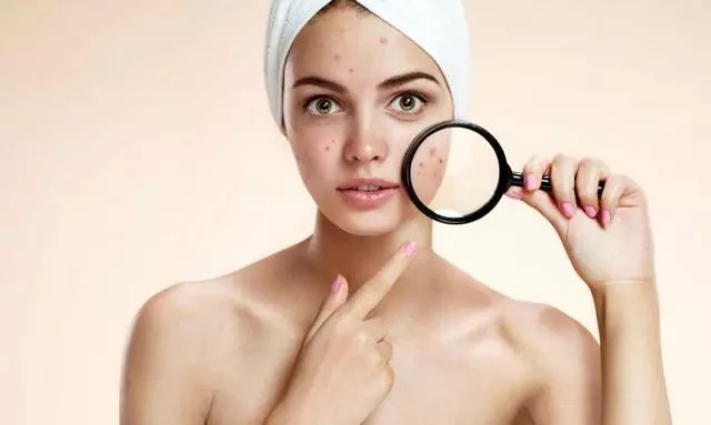 Retinol có trị mụn không?